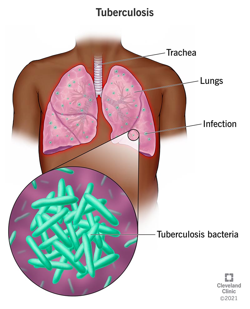 lung cancer.jpg